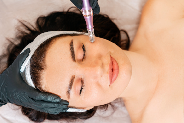 Experience the Transformative Effects of Skin Needling in Sydney